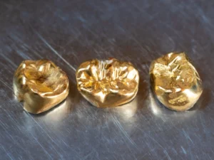 three dental gold crowns in a row