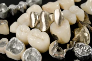 palladium metal dental crowns surrounded by teeth